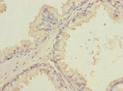Immunohistochemistry of paraffin-embedded human prostate cancer using CSB-PA013011ESR2HU at dilution of 1:100