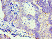 Immunohistochemistry of paraffin-embedded human ovarian cancer using CSB-PA013013ESR1HU at dilution of 1:100