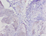 Immunohistochemistry of paraffin-embedded human colon cancer using CSB-PA013040LA01HU at dilution of 1:20