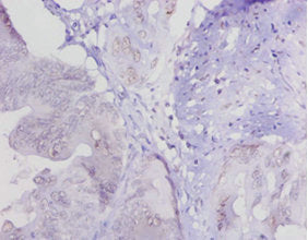 Immunohistochemistry of paraffin-embedded human colon cancer using CSB-PA013040LA01HU at dilution of 1:20