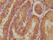 IHC image of CSB-PA013050LA01HU diluted at 1:200 and staining in paraffin-embedded human endometrial cancer performed on a Leica BondTM system. After dewaxing and hydration, antigen retrieval was mediated by high pressure in a citrate buffer (pH 6...