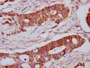 IHC image of CSB-PA013065LA01HU diluted at 1:800 and staining in paraffin-embedded human colon cancer performed on a Leica BondTM system. After dewaxing and hydration, antigen retrieval was mediated by high pressure in a citrate buffer (pH 6.0). S...