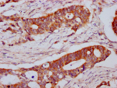 IHC image of CSB-PA013065LA01HU diluted at 1:800 and staining in paraffin-embedded human colon cancer performed on a Leica BondTM system. After dewaxing and hydration, antigen retrieval was mediated by high pressure in a citrate buffer (pH 6.0). S...