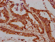 IHC image of CSB-PA013066LA01HU diluted at 1:300 and staining in paraffin-embedded human colon cancer performed on a Leica BondTM system. After dewaxing and hydration, antigen retrieval was mediated by high pressure in a citrate buffer (pH 6.0). S...