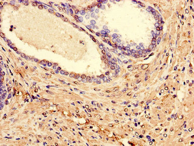 Immunohistochemistry of paraffin-embedded human prostate cancer using CSB-PA013068LA01HU at dilution of 1:100