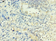 Immunohistochemistry of paraffin-embedded human lung cancer using CSB-PA013082ESR2HU at dilution of 1:100