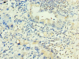 Immunohistochemistry of paraffin-embedded human lung cancer using CSB-PA013082ESR2HU at dilution of 1:100
