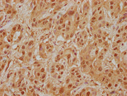 IHC image of CSB-PA013091NA01HU diluted at 1:400 and staining in paraffin-embedded human liver cancer performed on a Leica BondTM system. After dewaxing and hydration, antigen retrieval was mediated by high pressure in a citrate buffer (pH 6.0). S...