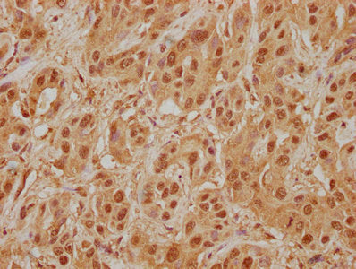 IHC image of CSB-PA013091NA01HU diluted at 1:400 and staining in paraffin-embedded human liver cancer performed on a Leica BondTM system. After dewaxing and hydration, antigen retrieval was mediated by high pressure in a citrate buffer (pH 6.0). S...