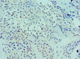 Immunohistochemistry of paraffin-embedded human breast cancer using CSB-PA013102ESR2HU at dilution of 1:100