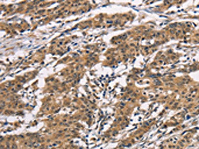 The image on the left is immunohistochemistry of paraffin-embedded Human gastic cancer tissue using CSB-PA013118(BAI1 Antibody) at dilution 1/40, on the right is treated with synthetic peptide. (Original magnification: ×200)