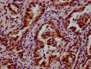 IHC image of CSB-PA013212LA01HU diluted at 1:600 and staining in paraffin-embedded human lung cancer performed on a Leica BondTM system. After dewaxing and hydration, antigen retrieval was mediated by high pressure in a citrate buffer (pH 6.0). Se...