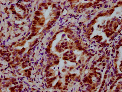 IHC image of CSB-PA013212LA01HU diluted at 1:600 and staining in paraffin-embedded human lung cancer performed on a Leica BondTM system. After dewaxing and hydration, antigen retrieval was mediated by high pressure in a citrate buffer (pH 6.0). Se...
