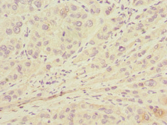 Immunohistochemistry of paraffin-embedded human liver cancer using CSB-PA013216ESR1HU at dilution of 1:100