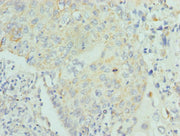 Immunohistochemistry of paraffin-embedded human lung cancer using CSB-PA013234ESR1HU at dilution of 1:100
