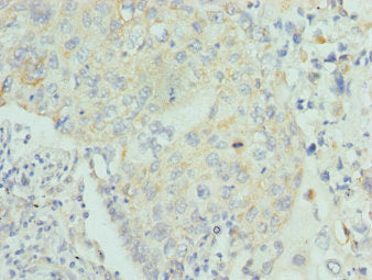 Immunohistochemistry of paraffin-embedded human lung cancer using CSB-PA013234ESR1HU at dilution of 1:100