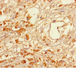 Immunohistochemistry of paraffin-embedded human melanoma using CSB-PA013331LA01HU at dilution of 1:100