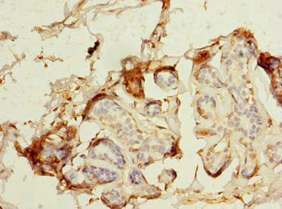 Immunohistochemistry of paraffin-embedded human breast cancer using CSB-PA013335LA01HU at dilution of 1:100