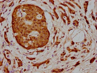 IHC image of CSB-PA013424LA01HU diluted at 1:400 and staining in paraffin-embedded human pancreatic cancer performed on a Leica BondTM system. After dewaxing and hydration, antigen retrieval was mediated by high pressure in a citrate buffer (pH 6....