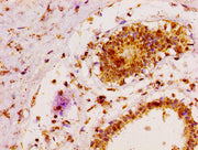 IHC image of CSB-PA013428LA01HU diluted at 1:100 and staining in paraffin-embedded human breast cancer performed on a Leica BondTM system. After dewaxing and hydration, antigen retrieval was mediated by high pressure in a citrate buffer (pH 6.0)....