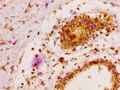 IHC image of CSB-PA013428LA01HU diluted at 1:100 and staining in paraffin-embedded human breast cancer performed on a Leica BondTM system. After dewaxing and hydration, antigen retrieval was mediated by high pressure in a citrate buffer (pH 6.0)....