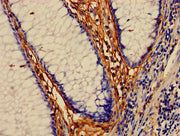 Immunohistochemistry of paraffin-embedded human colon cancer using CSB-PA013429LA01HU at dilution of 1:100