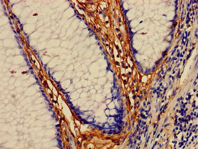 Immunohistochemistry of paraffin-embedded human colon cancer using CSB-PA013429LA01HU at dilution of 1:100