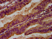 IHC image of CSB-PA013437LA01HU diluted at 1:500 and staining in paraffin-embedded human endometrial cancer performed on a Leica BondTM system. After dewaxing and hydration, antigen retrieval was mediated by high pressure in a citrate buffer (pH 6...