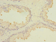 Immunohistochemistry of paraffin-embedded human prostate cancer using CSB-PA013494DSR2HU at dilution of 1:100