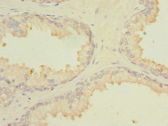 Immunohistochemistry of paraffin-embedded human prostate cancer using CSB-PA013494DSR2HU at dilution of 1:100