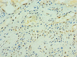 Immunohistochemistry of paraffin-embedded human breast cancer using CSB-PA013505ESR2HU at dilution of 1:100