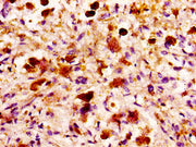 IHC image of CSB-PA013510LA01HU diluted at 1:100 and staining in paraffin-embedded human melanoma performed on a Leica BondTM system. After dewaxing and hydration, antigen retrieval was mediated by high pressure in a citrate buffer (pH 6.0). Secti...