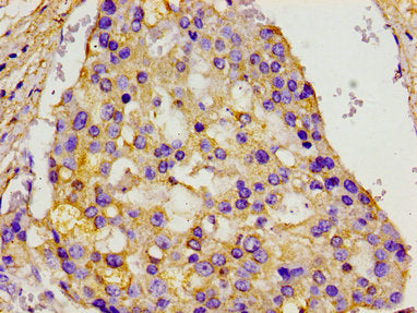 Immunohistochemistry of paraffin-embedded human breast cancer using CSB-PA013592LA01HU at dilution of 1:100