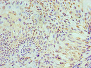 Immunohistochemistry of paraffin-embedded human breast cancer using CSB-PA013597ESR2HU at dilution of 1:100