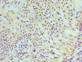Immunohistochemistry of paraffin-embedded human breast cancer using CSB-PA013597ESR2HU at dilution of 1:100