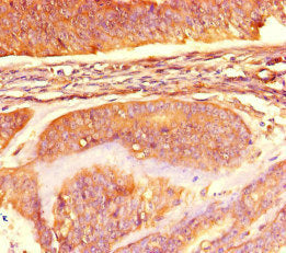 Immunohistochemistry of paraffin-embedded human endometrial cancer using CSB-PA013633HA01HU at dilution of 1:100