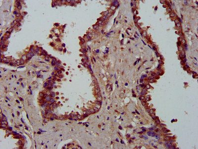 IHC image of CSB-PA013749LA01HU diluted at 1:300 and staining in paraffin-embedded human prostate cancer performed on a Leica BondTM system. After dewaxing and hydration, antigen retrieval was mediated by high pressure in a citrate buffer (pH 6.0)...