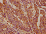 IHC image of CSB-PA013757LA01HU diluted at 1:100 and staining in paraffin-embedded human colon cancer performed on a Leica BondTM system. After dewaxing and hydration, antigen retrieval was mediated by high pressure in a citrate buffer (pH 6.0). S...