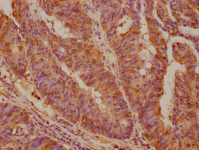 IHC image of CSB-PA013757LA01HU diluted at 1:100 and staining in paraffin-embedded human colon cancer performed on a Leica BondTM system. After dewaxing and hydration, antigen retrieval was mediated by high pressure in a citrate buffer (pH 6.0). S...