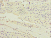 Immunohistochemistry of paraffin-embedded human liver cancer using CSB-PA013787ESR2HU at dilution of 1:100