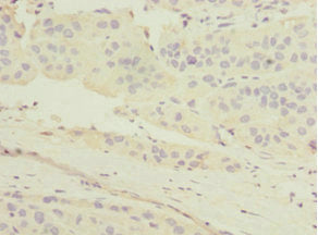 Immunohistochemistry of paraffin-embedded human liver cancer using CSB-PA013787ESR2HU at dilution of 1:100