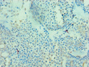Immunohistochemistry of paraffin-embedded human breast cancer using CSB-PA013806ESR2HU at dilution of 1:100