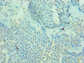 Immunohistochemistry of paraffin-embedded human breast cancer using CSB-PA013806ESR2HU at dilution of 1:100