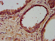 IHC image of CSB-PA013834LA01HU diluted at 1:200 and staining in paraffin-embedded human prostate cancer performed on a Leica BondTM system. After dewaxing and hydration, antigen retrieval was mediated by high pressure in a citrate buffer (pH 6.0)...