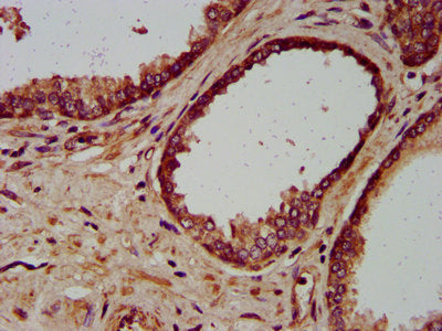 IHC image of CSB-PA013834LA01HU diluted at 1:200 and staining in paraffin-embedded human prostate cancer performed on a Leica BondTM system. After dewaxing and hydration, antigen retrieval was mediated by high pressure in a citrate buffer (pH 6.0)...