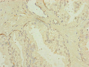 Immunohistochemistry of paraffin-embedded human prostate cancer using CSB-PA013835ESR1HU at dilution of 1:100