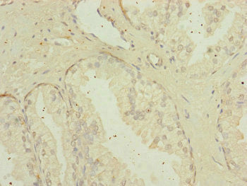 Immunohistochemistry of paraffin-embedded human prostate cancer using CSB-PA013835ESR1HU at dilution of 1:100