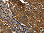 The image on the left is immunohistochemistry of paraffin-embedded Human cervical cancer tissue using CSB-PA014187(PPIA Antibody) at dilution 1/35, on the right is treated with fusion protein. (Original magnification: ×200)