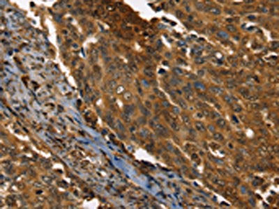 The image on the left is immunohistochemistry of paraffin-embedded Human cervical cancer tissue using CSB-PA014187(PPIA Antibody) at dilution 1/35, on the right is treated with fusion protein. (Original magnification: ×200)