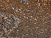The image on the left is immunohistochemistry of paraffin-embedded Human cervical cancer tissue using CSB-PA014278(MYBBP1A Antibody) at dilution 1/40, on the right is treated with synthetic peptide. (Original magnification: ×200)